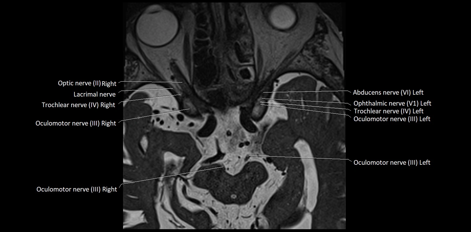 Cranial nerve anatomy axial MRI 3T image 17.webp